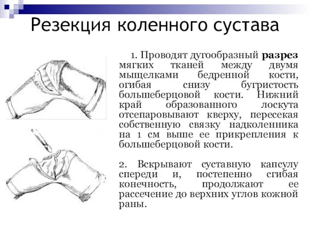 Резекция коленного сустава 1. Проводят дугообразный разрез мягких тканей между