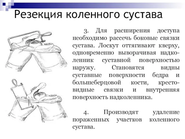 Резекция коленного сустава 3. Для расширения доступа необходимо рассечь боковые