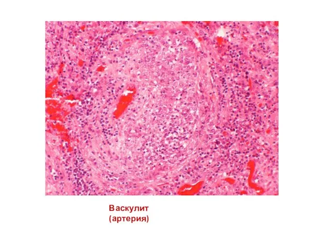Васкулит (артерия)