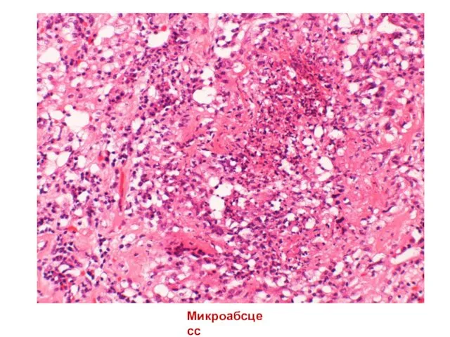 Микроабсцесс