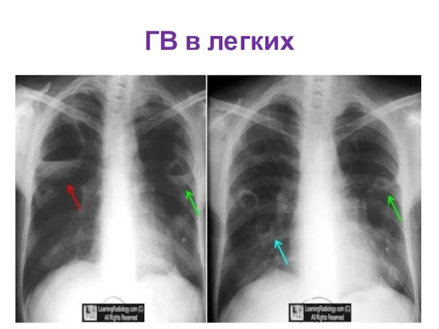 ГВ в легких