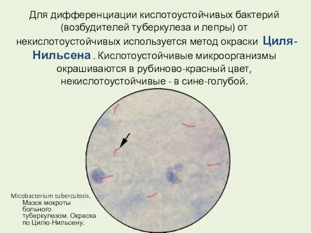 Для дифференциации кислотоустойчивых бактерий (возбудителей туберкулеза и лепры) от некислотоустойчивых используется метод окраски