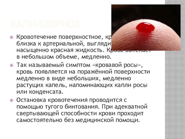 КАПИЛЛЯРНОЕ Кровотечение поверхностное, кровь по цвету близка к артериальной, выглядит