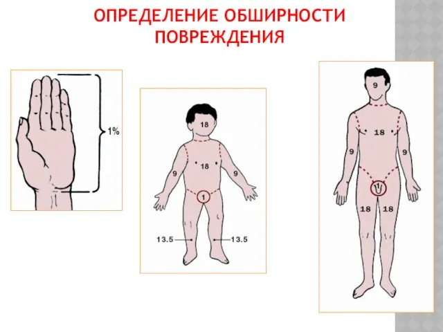 ОПРЕДЕЛЕНИЕ ОБШИРНОСТИ ПОВРЕЖДЕНИЯ