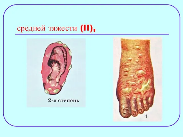 средней тяжести (II),