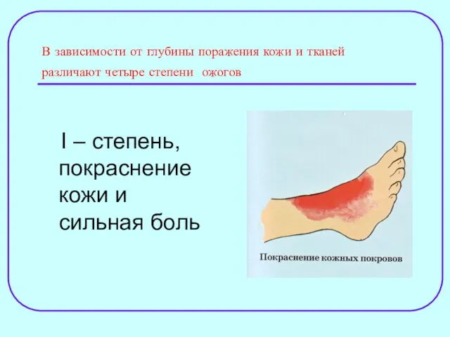 В зависимости от глубины поражения кожи и тканей различают четыре степени ожогов I