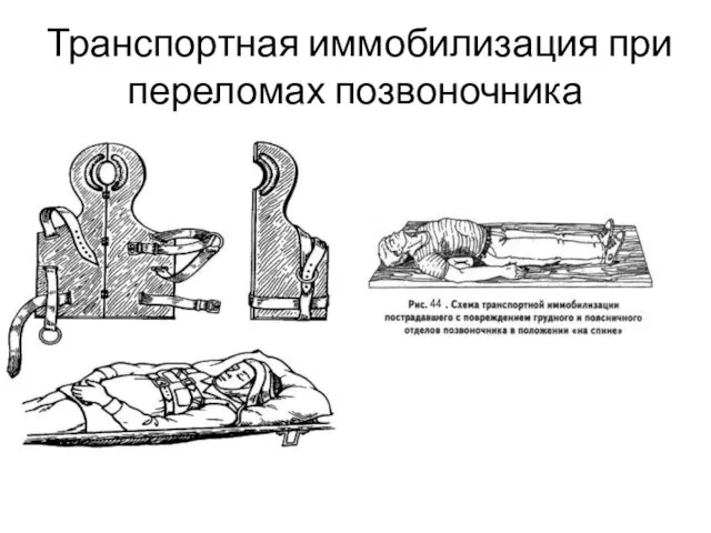 Транспортная иммобилизация при переломах позвоночника