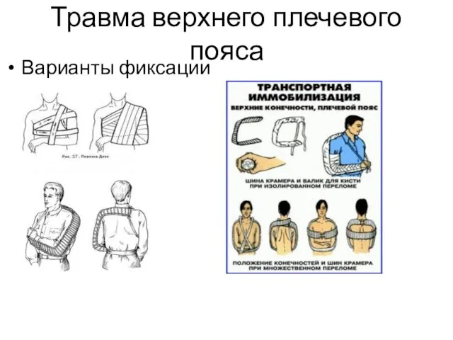 Травма верхнего плечевого пояса Варианты фиксации