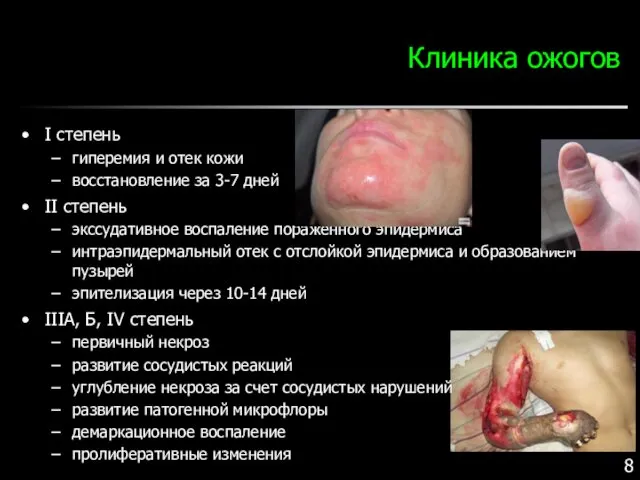 Клиника ожогов I степень гиперемия и отек кожи восстановление за