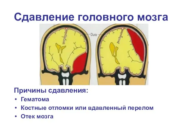 Сдавление головного мозга Причины сдавления: Гематома Костные отломки или вдавленный перелом Отек мозга