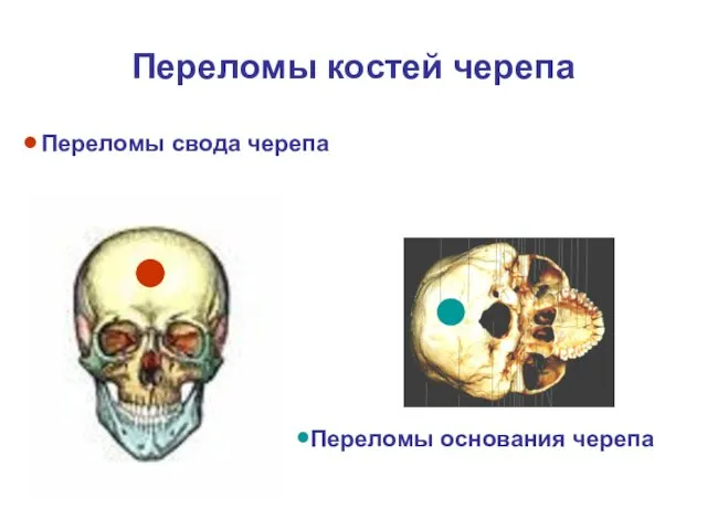 Переломы костей черепа Переломы свода черепа Переломы основания черепа