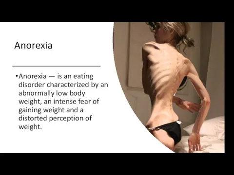 Anorexia Anorexia — is an eating disorder characterized by an