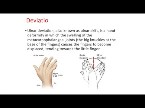 Deviatio Ulnar deviation, also known as ulnar drift, is a