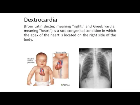 Dextrocardia (from Latin dexter, meaning "right," and Greek kardia, meaning