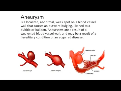 Аneurysm is a localized, abnormal, weak spot on a blood