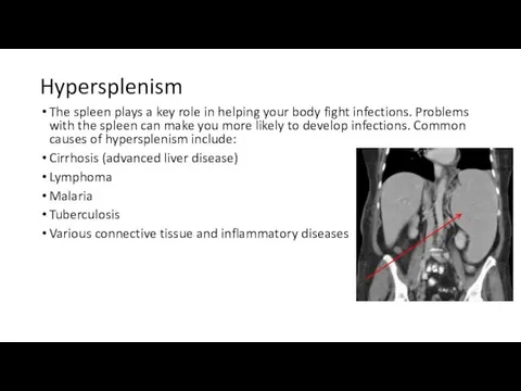 Hypersplenism The spleen plays a key role in helping your