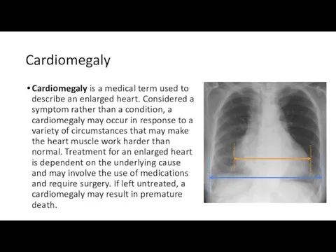 Cardiomegaly Cardiomegaly is a medical term used to describe an