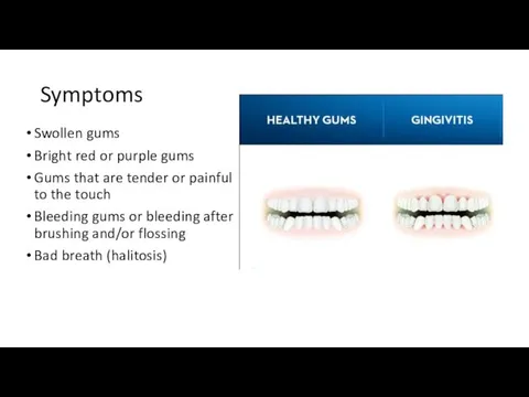 Symptoms Swollen gums Bright red or purple gums Gums that