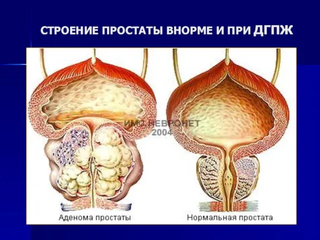 СТРОЕНИЕ ПРОСТАТЫ ВНОРМЕ И ПРИ ДГПЖ