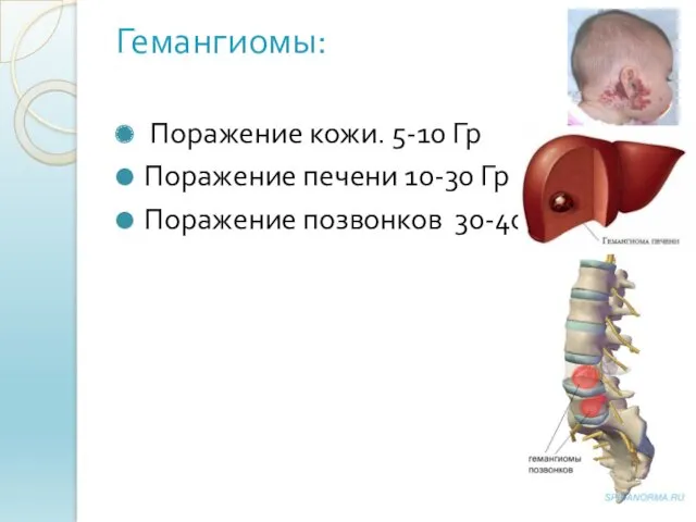 Гемангиомы: Поражение кожи. 5-10 Гр Поражение печени 10-30 Гр Поражение позвонков 30-40 Гр