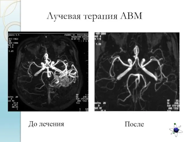 До лечения После Лучевая терапия АВМ