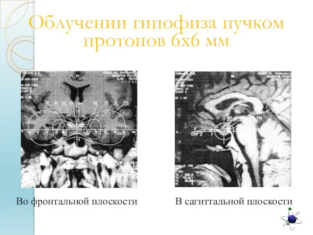 Облучении гипофиза пучком протонов 6х6 мм Во фронтальной плоскости В сагиттальной плоскости