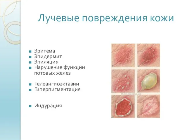 Лучевые повреждения кожи Эритема Эпидермит Эпиляция Нарушение функции потовых желез Телеангиоэктазии Гиперпигментация Индурация