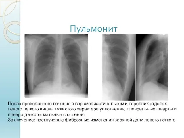 Пульмонит После проведенного лечения в парамедиастинальном и передних отделах левого