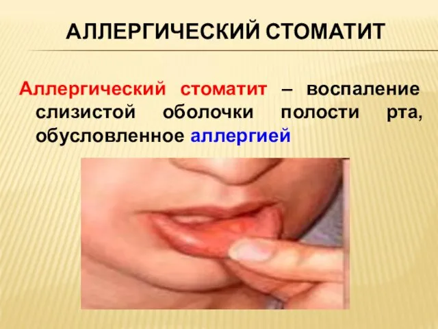 АЛЛЕРГИЧЕСКИЙ СТОМАТИТ Аллергический стоматит – воспаление слизистой оболочки полости рта, обусловленное аллергией