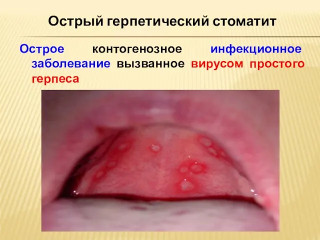 Острый герпетический стоматит Острое контогенозное инфекционное заболевание вызванное вирусом простого герпеса