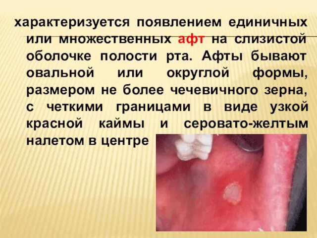 характеризуется появлением единичных или множественных афт на слизистой оболочке полости