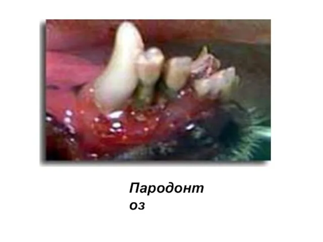 Пародонтоз