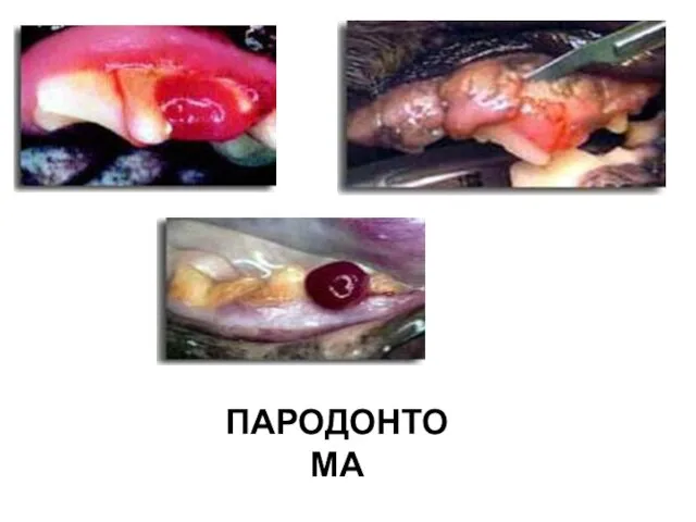 ПАРОДОНТОМА