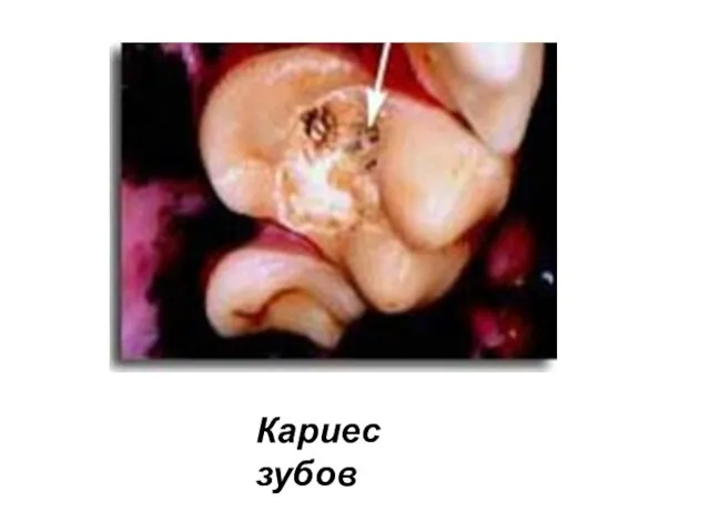 Кариес зубов