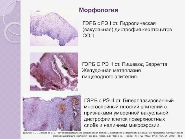 ГЭРБ с РЭ I ст. Гидропическая (вакуольная) дистрофия кератоцитов СОП.