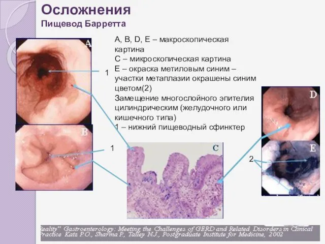 A, B, D, E – макроскопическая картина С – микроскопическая