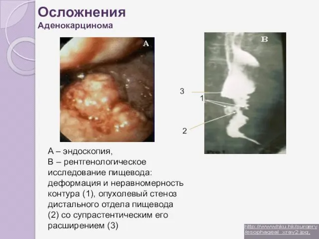 Осложнения Аденокарцинома A – эндоскопия, B – рентгенологическое исследование пищевода: