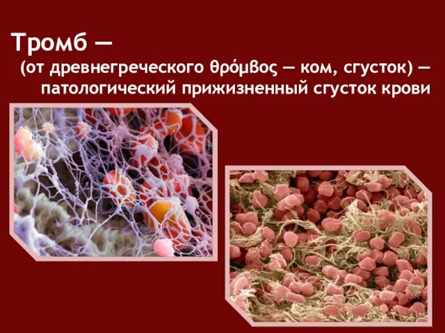 Тромб ― (от древнегреческого θρόμβος — ком, сгусток) — патологический прижизненный сгусток крови