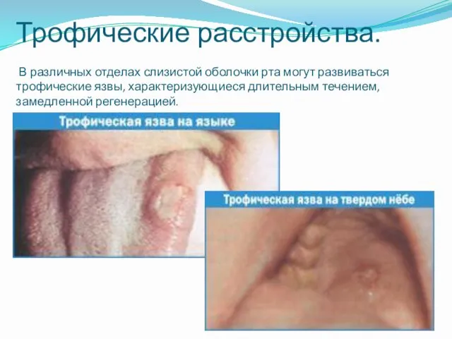 Трофические расстройства. В различных отделах слизистой оболочки рта могут развиваться