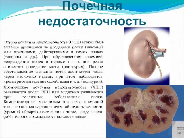 Почечная недостаточность Острая почечная недостаточность (ОПН) может быть вызвана причинами