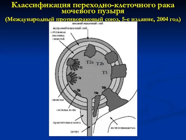 Классификация переходно-клеточного рака мочевого пузыря (Международный противораковый союз, 5-е издание, 2004 год) Т2а Т2b Т3