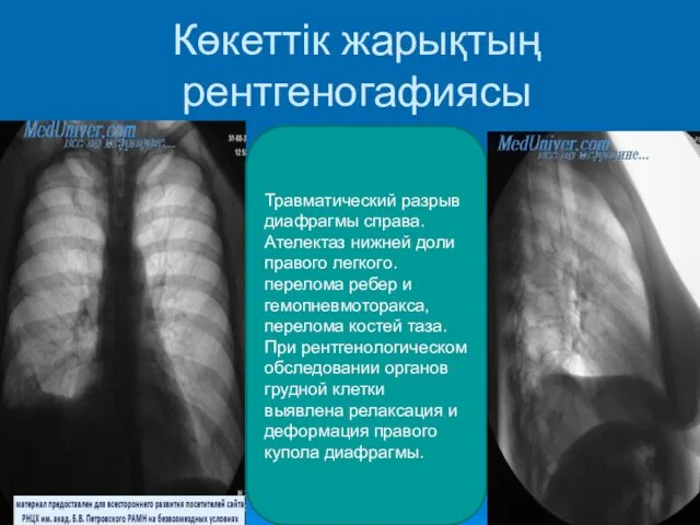 Көкеттік жарықтың рентгеногафиясы Травматический разрыв диафрагмы справа. Ателектаз нижней доли правого легкого. перелома