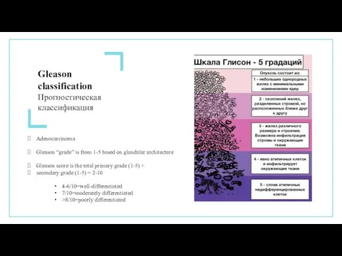 Adenocarcinoma Gleason “grade” is from 1-5 based on glandular architecture