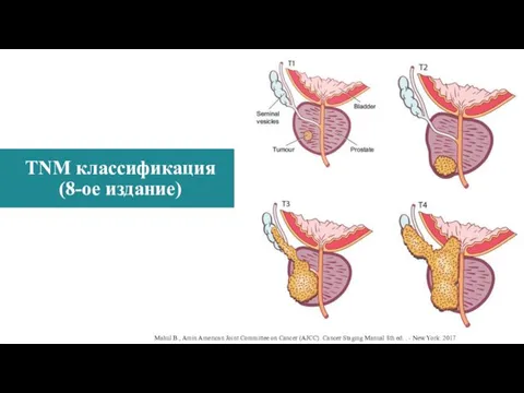 TNM классификация (8-ое издание) T - tumor Mahul B., Amin