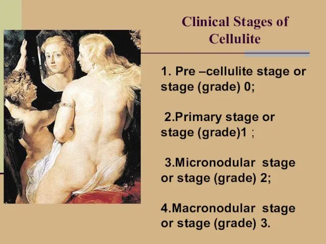 Clinical Stages of Cellulite 1. Pre –cellulite stage or stage