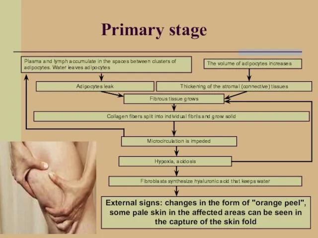 Primary stage Plasma and lymph accumulate in the spaces between