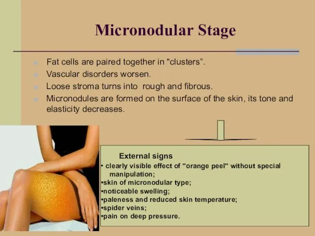 Micronodular Stage Fat cells are paired together in "clusters“. Vascular