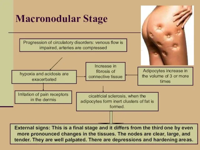 Macronodular Stage Progression of circulatory disorders: venous flow is impaired,