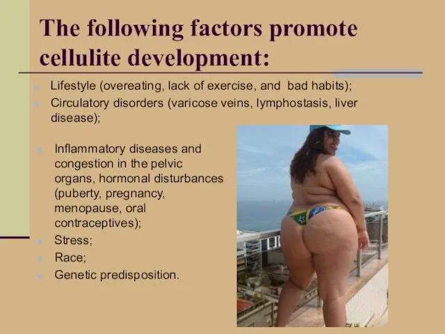 The following factors promote cellulite development: Lifestyle (overeating, lack of