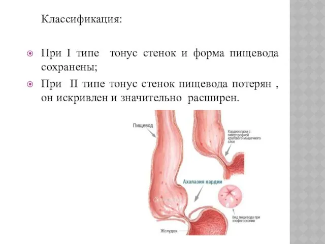 Классификация: При I типе тонус стенок и форма пищевода сохранены;